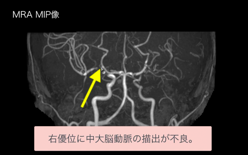 頭部MRAの撮影の意義は？わかることは？